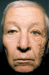 Mans Face with unilateral dermatoheliosis